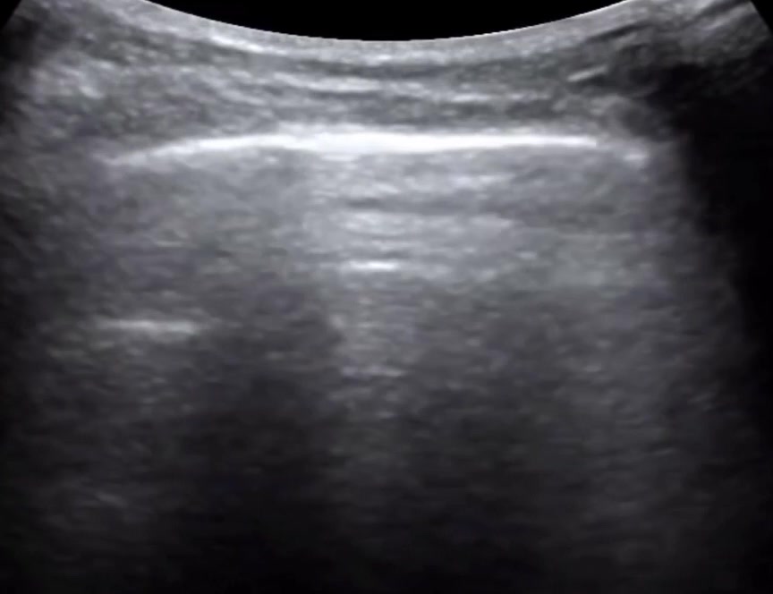Machine Learning-guided Screening of COVID-19 using Point-of-Care Ultrasound in Uganda