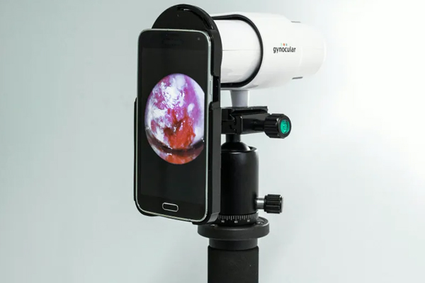 Real-time Tele- consultation for Cervical Cancer Screening Using a Machine  Learning-enabled Mobile App