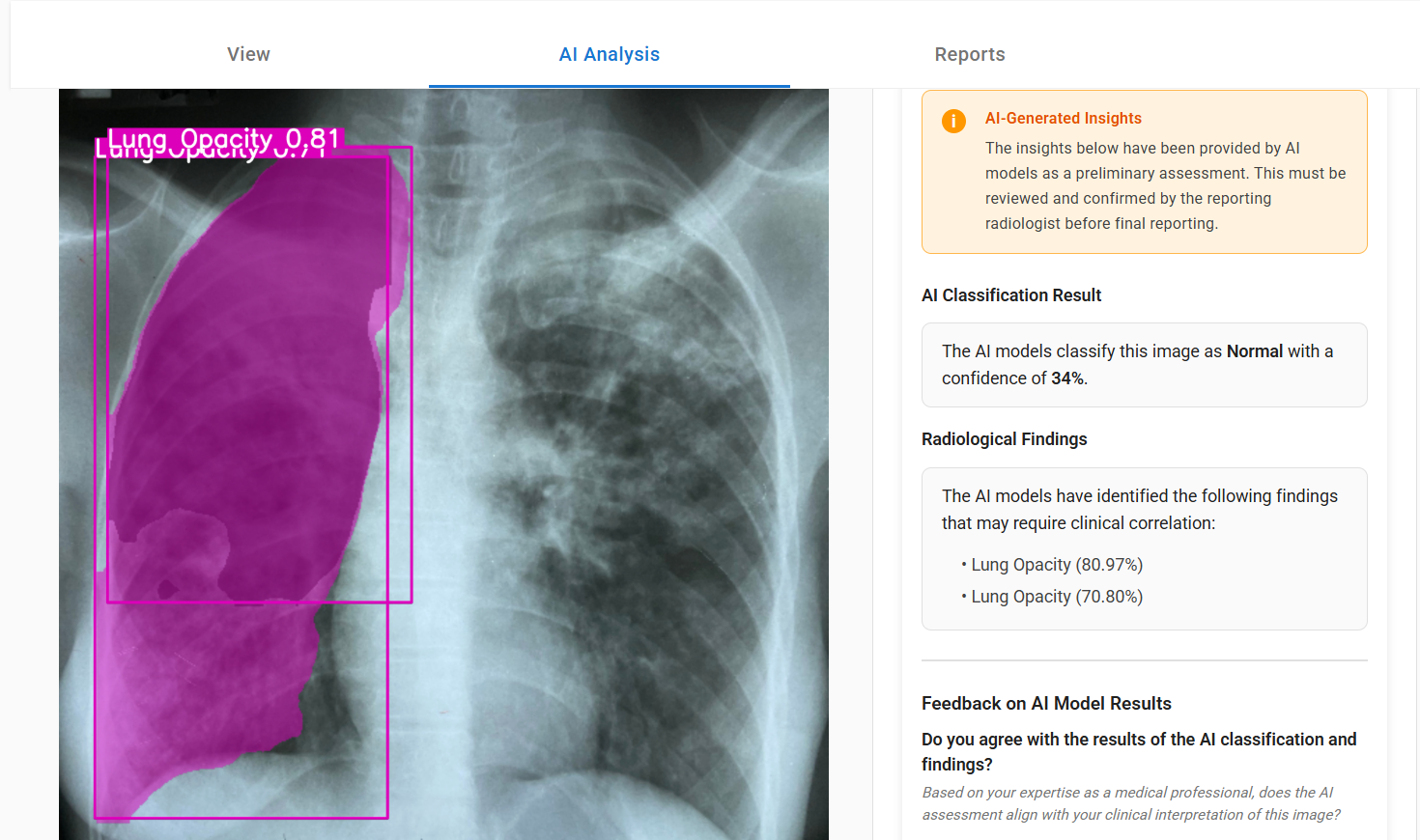 Chest X-ray used for tuberculosis screening